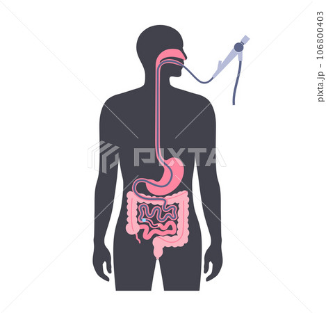 Balloon assisted enteroscopy 106800403