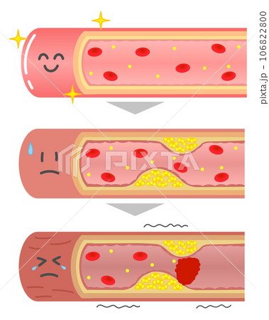 進行する動脈硬化の血管断面図の表情付きイラスト 進行する動脈硬化の血管断面図の表情付きイラスト 106822800