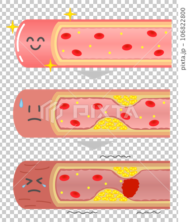 進行する動脈硬化の血管断面図の表情付きイラスト 進行する動脈硬化の血管断面図の表情付きイラスト 106822800