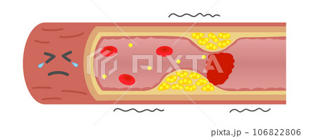 血栓で閉塞して苦しそうな動脈硬化の血管のイラスト（横） 106822806