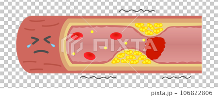 血栓で閉塞して苦しそうな動脈硬化の血管のイラスト（横） 106822806