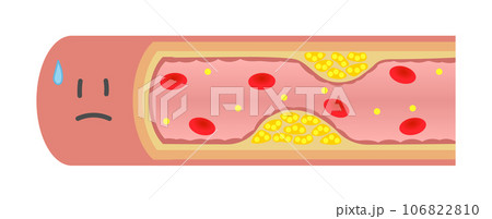 動脈硬化で内部が狭窄して困っている血管のイラスト(横) 動脈硬化で内部が狭窄して困っている血管のイラスト(横) 106822810