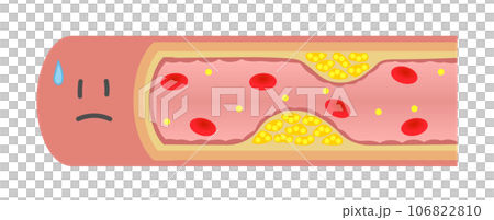 動脈硬化で内部が狭窄して困っている血管のイラスト(横) 動脈硬化で内部が狭窄して困っている血管のイラスト(横) 106822810
