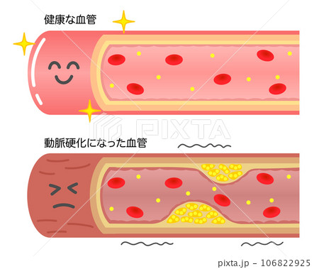健康な血管と動脈硬化で狭窄した血管の比較イラスト 健康な血管と動脈硬化で狭窄した血管の比較イラスト 106822925