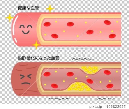 Comparison illustration of healthy blood vessels and blood vessels narrowed due to arteriosclerosis Comparison illustration of healthy blood vessels and blood vessels narrowed due to arteriosclerosis 106822925