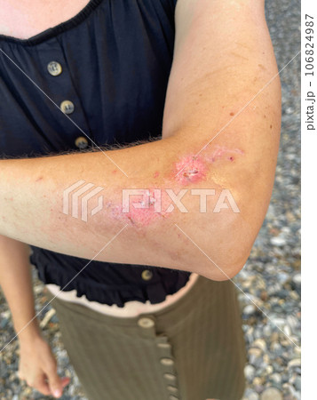 Woman with a scar on her arm after car accident Woman with a scar on her arm after car accident 106824987