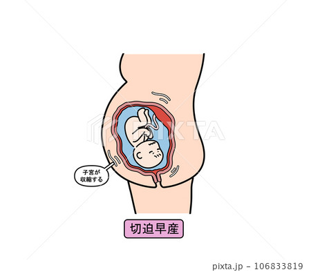 切迫早産 切迫早産 106833819