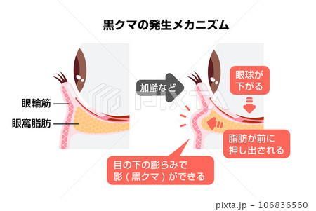 目のくま(黒クマ) の発生原因 (下眼瞼断面図イラスト) 目のくま(黒クマ) の発生原因 (下眼瞼断面図イラスト) 106836560
