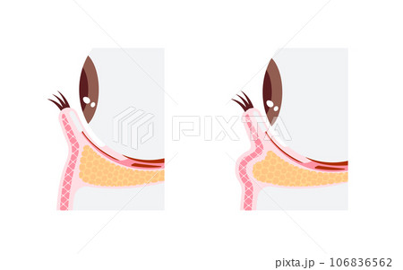正常な下眼瞼と目のくま(黒クマ) の発生した下眼瞼 / 断面図イラスト 正常な下眼瞼と目のくま(黒クマ) の発生した下眼瞼 / 断面図イラスト 106836562
