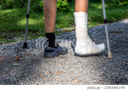 Broken ankle and a leg cast. Leg splint Broken ankle and a leg cast. Leg splint 106846149