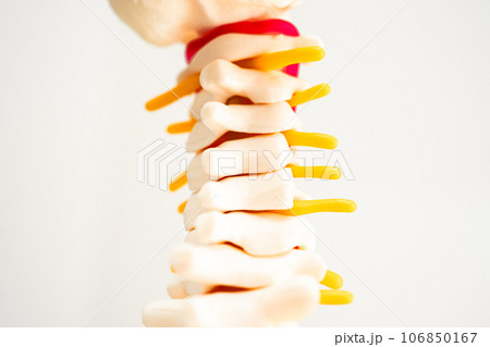 Lumbar spine displaced herniated disc fragment, spinal nerve and bone. Model on white background with clipping path, for treatment medical in the orthopedic department. 106850167