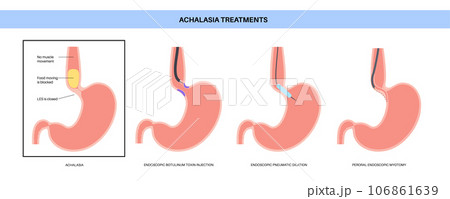 Achalasia treatments procedures Achalasia treatments procedures 106861639