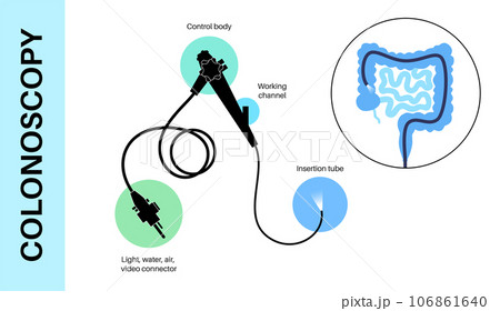 Colonoscopy medical procedure Colonoscopy medical procedure 106861640
