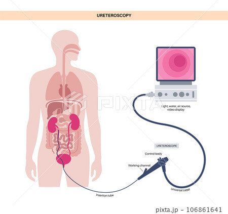 Ureteroscopy medical poster 106861641
