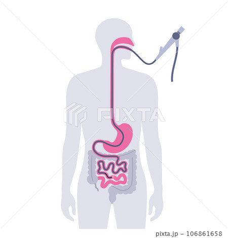 Esophagogastroduodenoscopy medical procedure 106861658