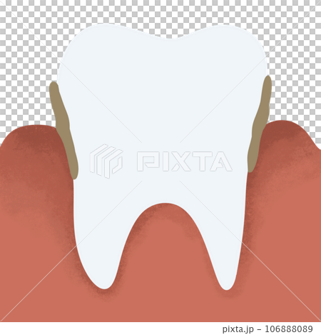 Tartar and bactrail tooth plaque, lower jaw. Medically accurate  illustration of human teeth treatment 106888089