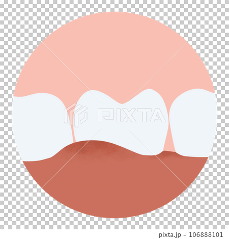 Tartar and bactrail tooth plaque, lower jaw. Medically accurate  illustration of human teeth treatment 106888101