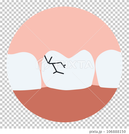 Cracked tooth, splitted. Medically accurate  illustration 106888150