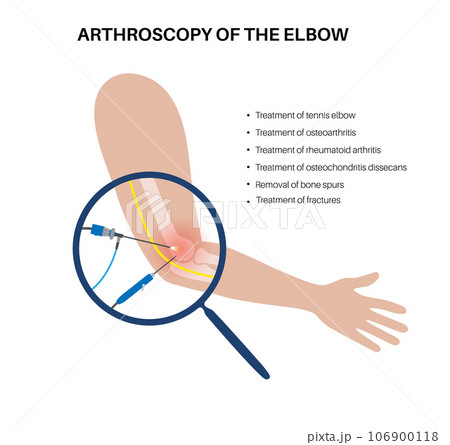 Elbow arthroscopy surgery Elbow arthroscopy surgery 106900118