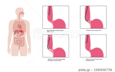 POEM medical poster 106946736