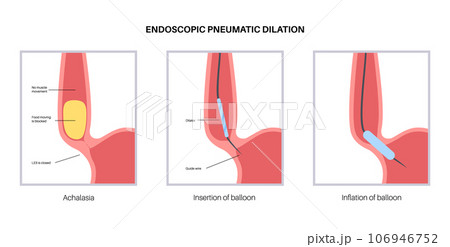 Endoscopic pneumatic dilation Endoscopic pneumatic dilation 106946752