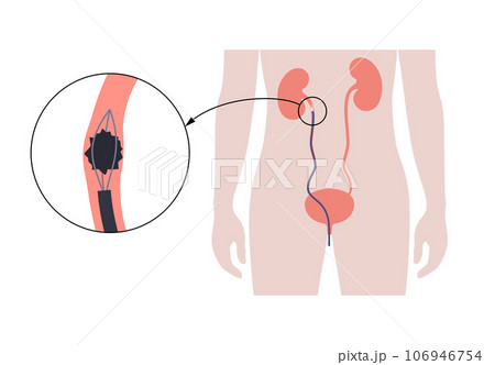 Ureteroscopy medical poster 106946754