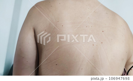 a mark from a woman's bra on the shoulders a mark from a woman's bra on the shoulders 106947698