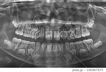 X ray of child teeth X ray of child teeth 106967975
