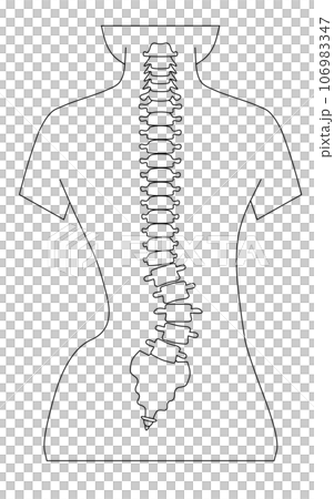 脊椎側彎的簡單圖示 106983347