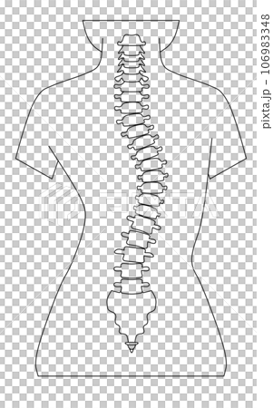 脊椎側彎的簡單圖示 106983348