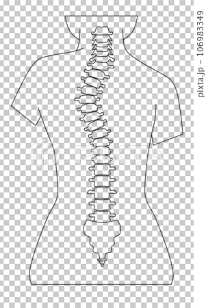 脊椎側彎的簡單圖示 106983349