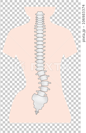脊椎側彎的簡單圖示 脊椎側彎的簡單圖示 106983374
