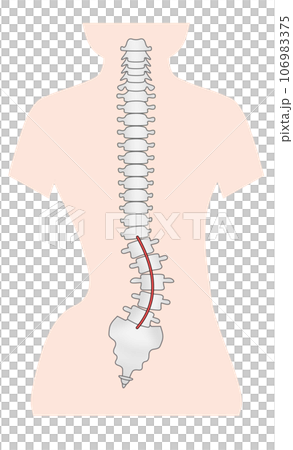 脊椎側彎的簡單圖示 脊椎側彎的簡單圖示 106983375