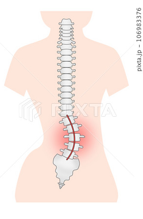 側湾症の背骨のシンプルなイラスト 側湾症の背骨のシンプルなイラスト 106983376