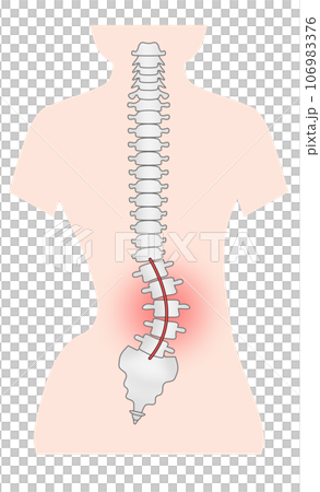 側湾症の背骨のシンプルなイラスト 側湾症の背骨のシンプルなイラスト 106983376