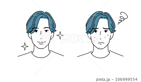 ニキビに悩む男性・解決して笑顔の男性 ニキビに悩む男性・解決して笑顔の男性 106999554