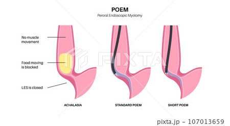 POEM medical poster 107013659