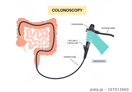 Colonoscopy medical procedure 107013660