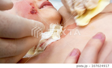 dressing a boy with a burn from boiling water 107024917