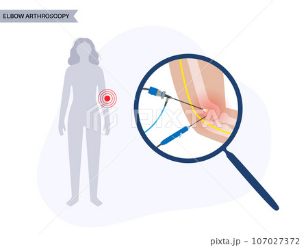 Elbow arthroscopy surgery 107027372