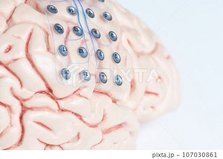 Subdural grid electrode for brain waves recording on the brain model 107030861