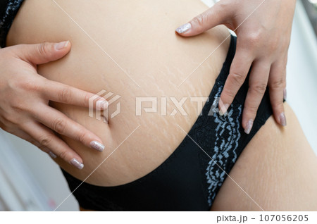 Abdominal scar marked pattern skin from women who have been pregnant Abdominal scar marked pattern skin from women who have been pregnant 107056205
