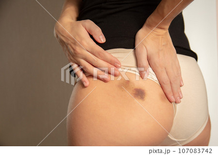 A woman checking her buttock with bruises on it after injections. Closeup. A woman checking her buttock with bruises on it after injections. Closeup. 107083742