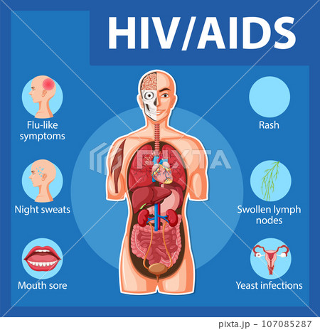 HIV/AIDS Virus: Effects on Human Immune Systemのイラスト素材 [107085287] - PIXTA
