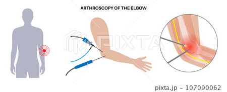 Elbow arthroscopy surgery 107090062