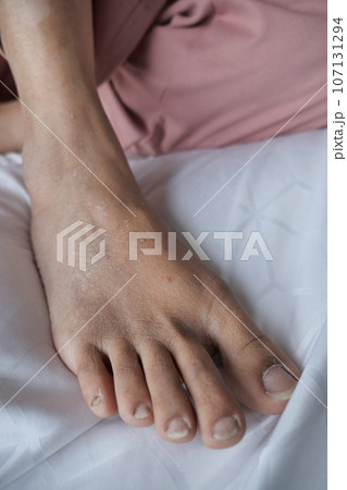 close up of women feet with swelling  107131294