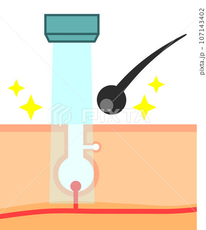 無駄毛を処理するレーザー脱毛で毛が抜ける断面のイラスト 無駄毛を処理するレーザー脱毛で毛が抜ける断面のイラスト 107143402