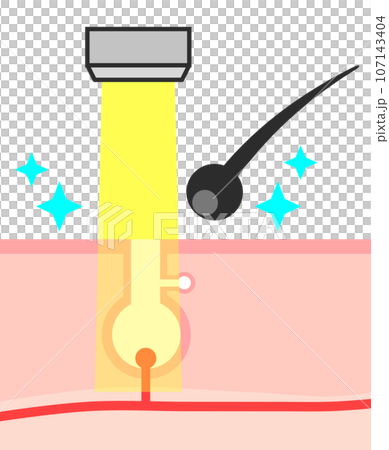 Illustration of a cross section of hair being removed by laser hair removal to remove unwanted hair Illustration of a cross section of hair being removed by laser hair removal to remove unwanted hair 107143404