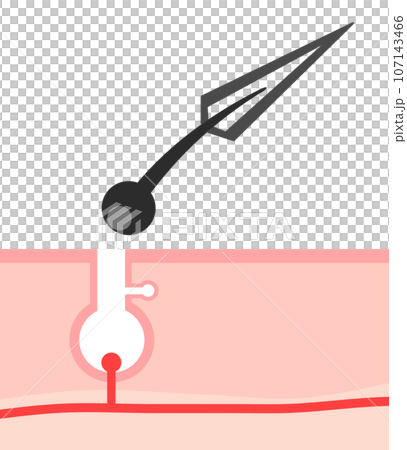無駄毛を毛抜きで抜く時の肌の断面イラスト 107143466