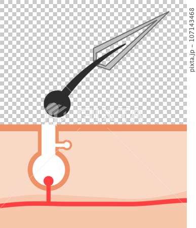 無駄毛を毛抜きで抜く時の肌の断面イラスト 無駄毛を毛抜きで抜く時の肌の断面イラスト 107143468